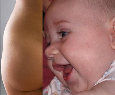 Babies and cellulite